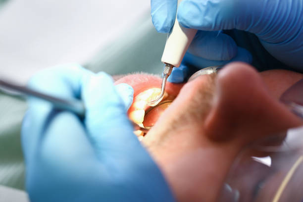 Best Emergency Root Canal Therapy in Beaumont, TX